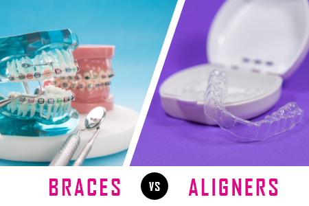 Galleria of Smiles explain the difference between braces & clear aligners