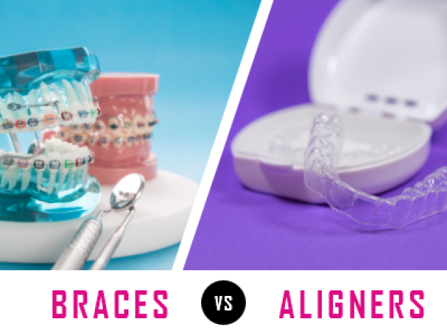 How to Decide Between Braces and Clear Aligners (featured image)