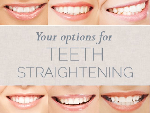 Your Options for Teeth Straightening (featured image)