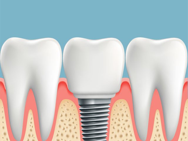 Your Intro to Dental Implants (featured image)