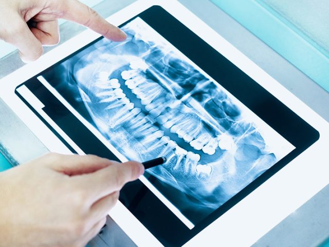 Dental X-Rays & Radiation Exposure (featured image)