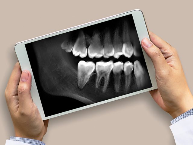 Taking the X-Factor Out of Dental X-Rays (featured image)